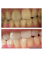 パルティノ 高崎店/セルフホワイトニング