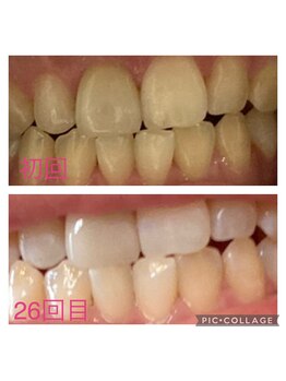 パルティノ 高崎店/セルフホワイトニング