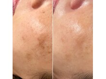 ジン フォー ユアビューティー(JIN for your beauty)/施術経過