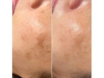 ジン フォー ユアビューティー(JIN for your beauty)/施術経過