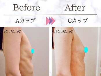エムエムエム 表参道Luxeサロン(M.M.M)/【バストアップ例】　A→Cカップ