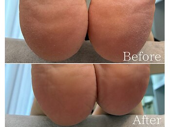 カシェット 広島店(Cachette)/50代女性☆足裏角質ケア90分