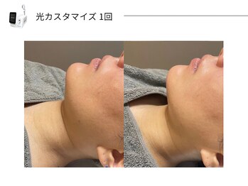 スパレーカ(Spa laka)/光カスタマイズ