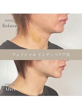 術後の女神 大阪本町店/ダウンタイムケア・インディバ