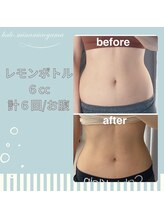 ハロ 南青山(HALO)/レモンボトル月2回×3ヶ月経過