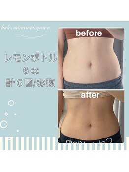 ハロ 南青山(HALO)/レモンボトル月2回×3ヶ月経過