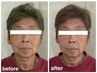 40,50,60代の方【顔の下半分たるみ】根本改善!小顔矯正+頭蓋骨矯正