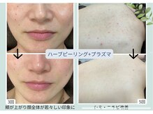 ウェルビー(Well-Be)の雰囲気（ハーフピーリング＋プラズマで驚きの変化！）