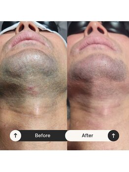 ユーフェム(U-fem)/ヒゲ脱毛10回目のお客様