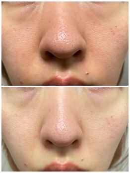 ジョルジオ東京/プラズマフラクショナル