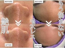 アンシャンテ(Anchant)/【お鼻の黒ずみ、実は産毛！】