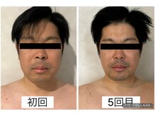 エクラ(Eclat)/Eclatの痩身★before/after18
