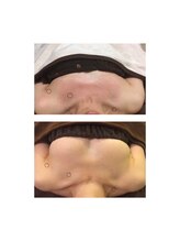 リノ 行橋(lino)/◇バストアップ症例◇施術:6回