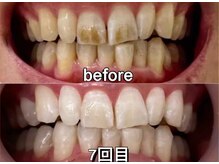 グラーティア 梅田店(gratia)/ホワイトニング★7回目★