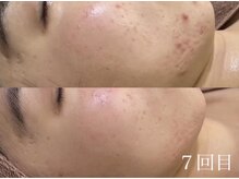 アワピール 天王寺店(AWA PEELL)/ハーブピーリング/毛穴/天王寺