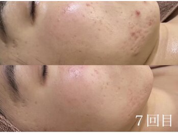 アワピール 天王寺店(AWA PEELL)/ハーブピーリング/毛穴/天王寺