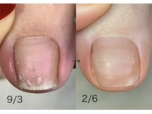 ロンディネ(Rondine)/巻き爪ケア&Nail trim