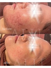 アルフォービューティー 恵比寿店(ALU for beauty)/ニキビ・赤み症例