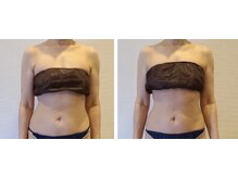 サロンサンティ/ぽっこりお腹ケア