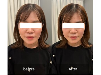 クレファ(CREFA)/美顔整骨