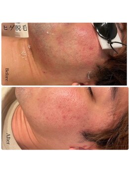 エクラ(eclat)/メンズ脱毛