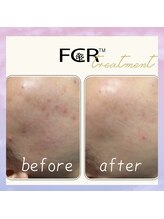 シャルム ココ 八尾店(Charme coco)/ニキビケア　１回目