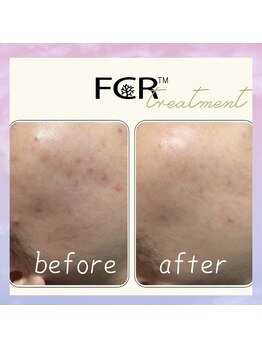 シャルム ココ 八尾店(Charme coco)/ニキビケア　１回目