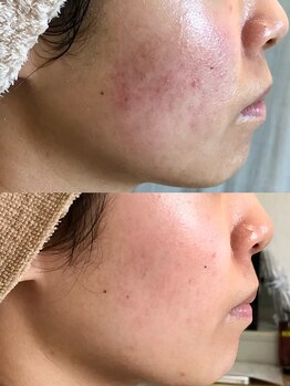 カルナ(CARNA)/ドラブル肌もなかったことに