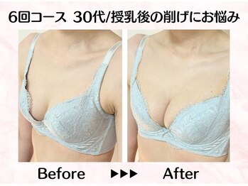 美人バスト リグラス(ReGrous)/バストアップbefore,after
