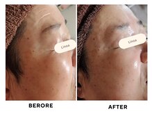 リノア(Linoa)/before/after
