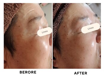 リノア(Linoa)/before/after