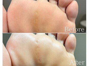 カシェット 広島店(Cachette)/50代女性☆足裏角質ケア90分