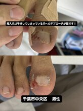 巻き爪じゅん 船橋店/深く刺さった陥入爪による痛み