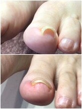 モアクリスタル(More Crystal)/巻き爪補正