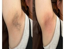 サロンドエピレーション トパーズ(Salon d’ epilation TOPARDS)/両わきワックス脱毛