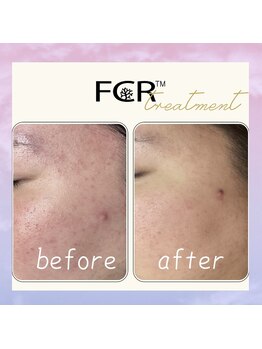 シャルム ココ 八尾店(Charme coco)/赤みケア　１回目