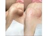 毛穴レス【詰まり/黒ずみ/いちご鼻】大人気◎ユウェール式毛穴治療プログラム