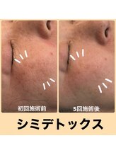 モカ(MOKA)/シミケア