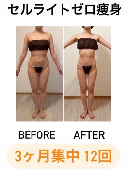 カルナ(CARNA)/【痩身】セルライトゼロ2