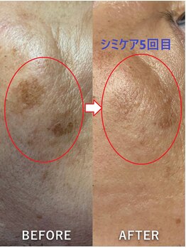 ヒトハダ(hitohada)/50代男性 《シミケア5回》