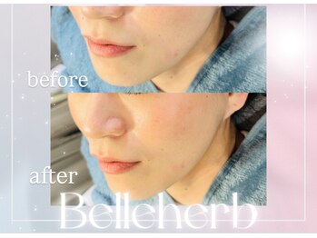 ベルハーブ(Belle herb)/30代/光フェイシャル/たるみ小顔
