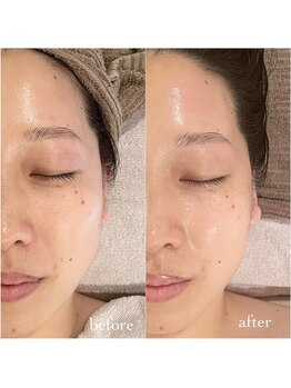 ニコテ(Nicote)/肌育ボンバーフェイシャル