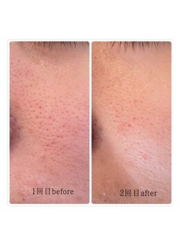 ユフラ(Juhla)/韓国式ハーブピーリング