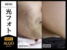 アルゴ 敦賀店(ALGO)/メンズ光フォト