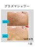 【期間限定】プラズマシャワーフェイシャル|紫外線ダメージ・毛穴集中ケア