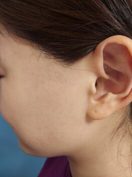 キアラ 麻布十番(Kiara)/もみあげ脱毛アフター