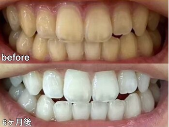 グラーティア 梅田店(gratia)/ホワイトニング★6ヶ月目★