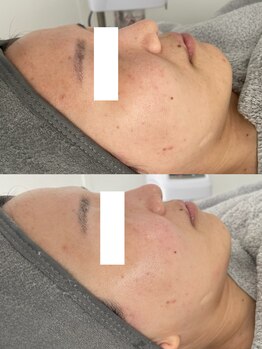 クレア(CLEA)/月1のワックスで肌質改善