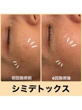 モカ(MOKA)/シミケア