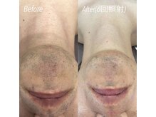 ハイリー(Hily)/ひげ &nbsp;before、after